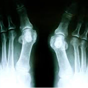 Lumpy and sore big toe? Read on as we dissect the Bunion.