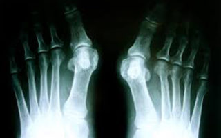 Lumpy and sore big toe? Read on as we dissect the Bunion.